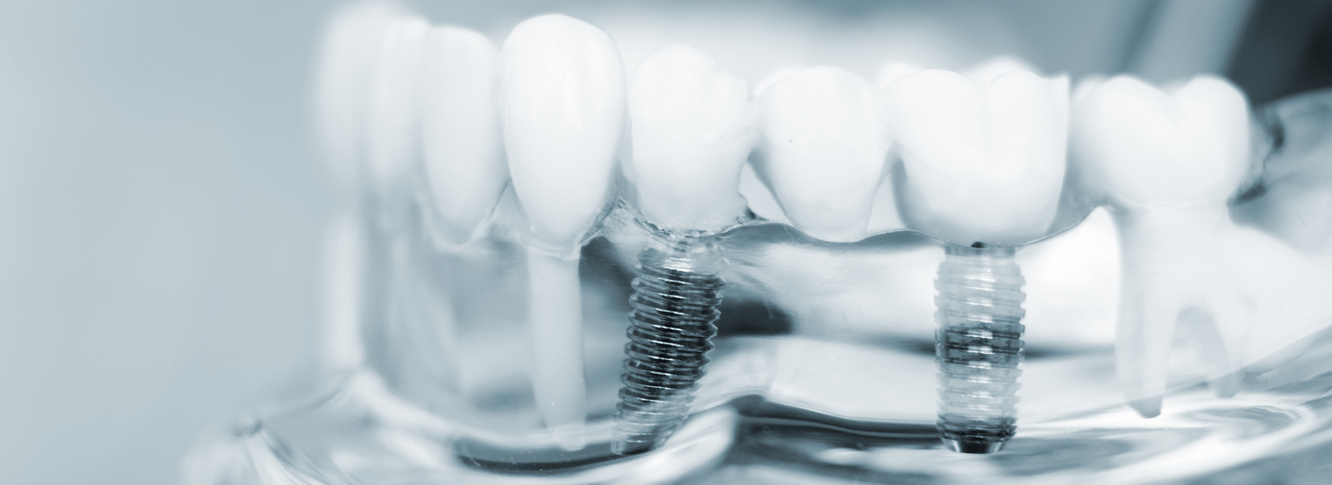 Napa Dental | Extractions, Orthodontics and Veneers