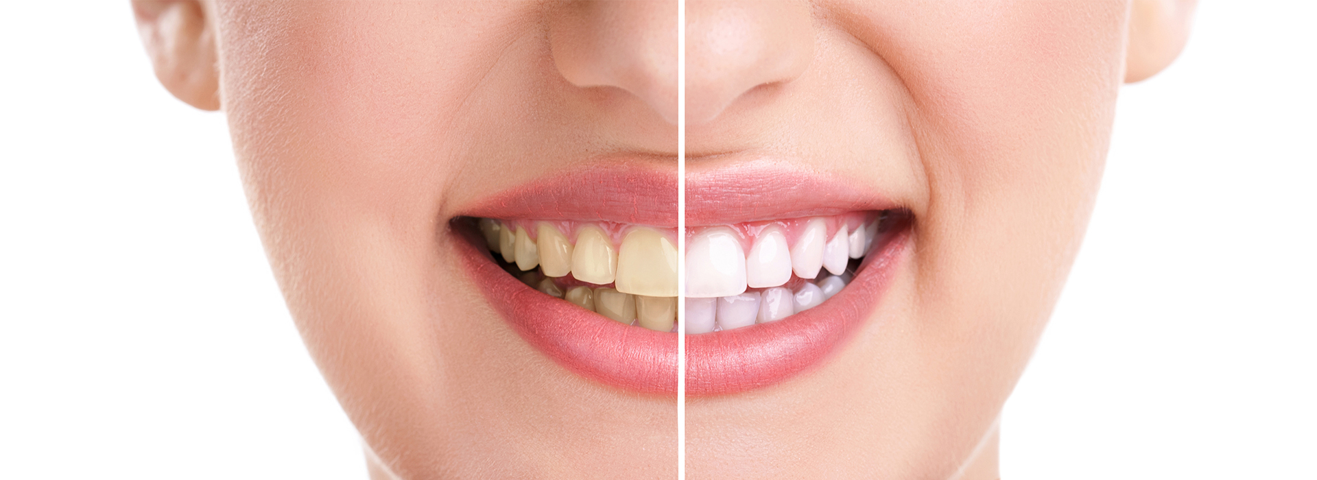 Napa Dental | Implant Dentistry, Dental Cleanings and Teeth Whitening